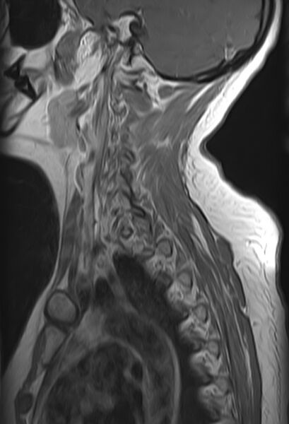 File:Astrocytoma - spinal cord (Radiopaedia 69769-79758 Sagittal T1 C+ 11).jpg