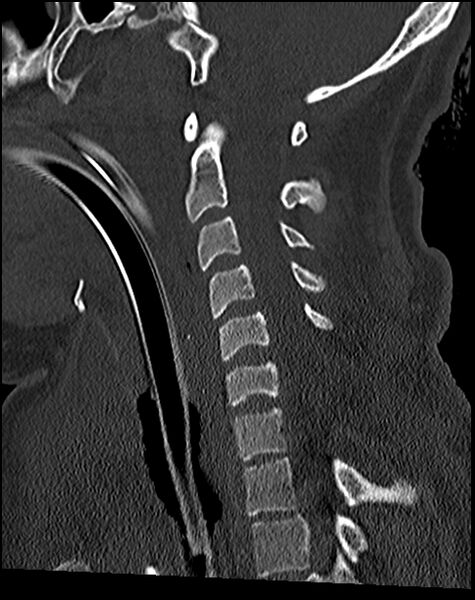 File:Atlanto-occipital dissociation - Traynelis type 1 (Radiopaedia 87570-103948 Sagittal bone window 48).jpg