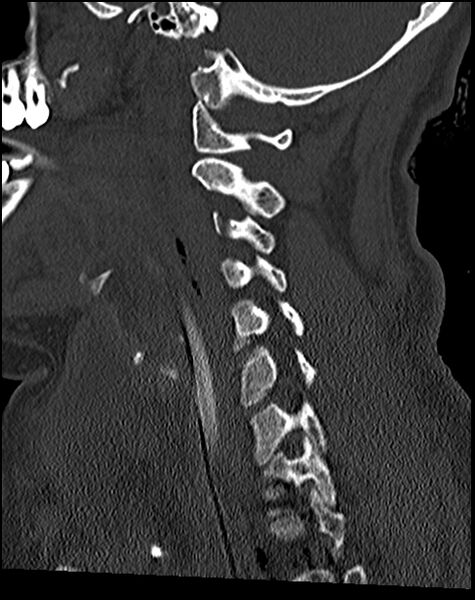 File:Atlanto-occipital dissociation - Traynelis type 1 (Radiopaedia 87570-103948 Sagittal bone window 53).jpg