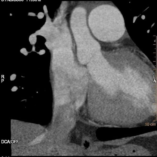File:Atrial septal defect (upper sinus venosus type) with partial anomalous pulmonary venous return into superior vena cava (Radiopaedia 73228-84051 C+ arterial phase 5).jpeg