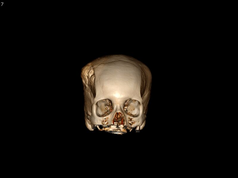 File:Atypical meningioma - intraosseous (Radiopaedia 64915-73867 3D volume render 7).jpg
