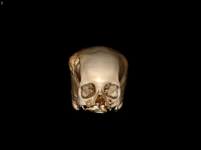 Atypical meningioma - intraosseous (Radiopaedia 64915-73867 3D volume render 7).jpg