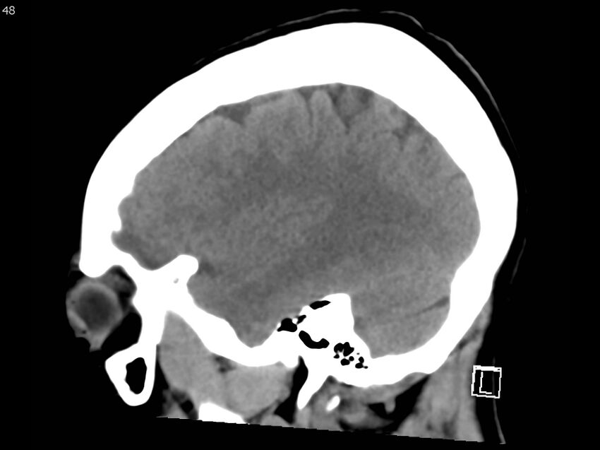 Atypical meningioma - intraosseous (Radiopaedia 64915-73867 C 46).jpg
