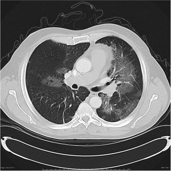 File:Atypical pneumonia - Q fever (Radiopaedia 21993-21989 lung window 20).jpg