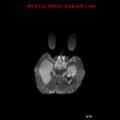 Atypical teratoid rhabdoid tumor (Radiopaedia 10712-11183 Axial DWI 11).jpg
