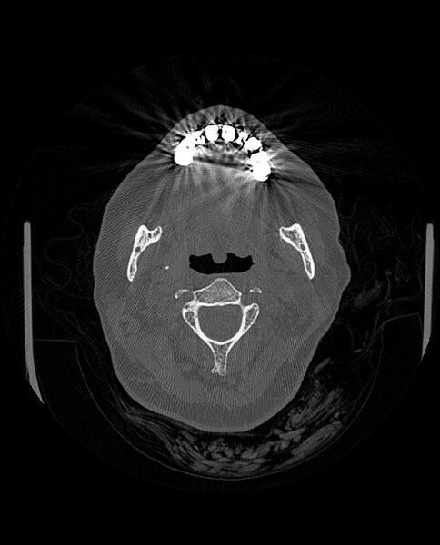 File:Automastoidectomy with labyrinthine fistula (Radiopaedia 84143-99411 Axial non-contrast 10).jpg