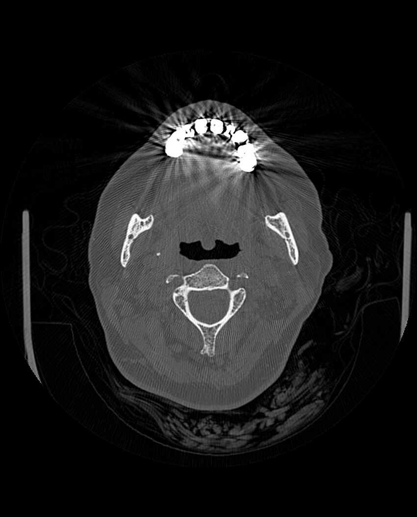 Automastoidectomy with labyrinthine fistula (Radiopaedia 84143-99411 Axial non-contrast 10).jpg