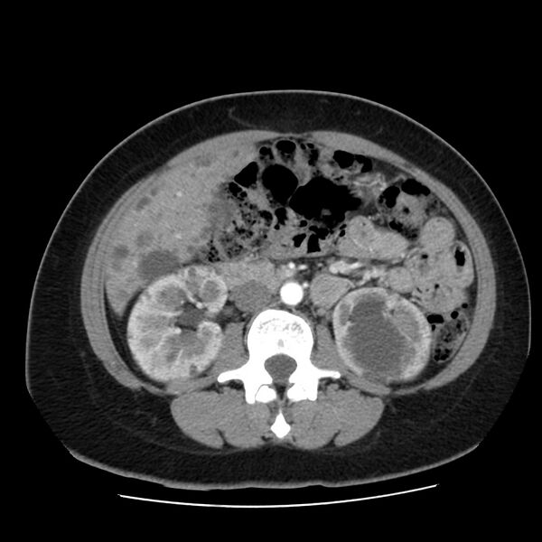 File:Autosomal dominant polycystic kidney disease (Radiopaedia 23061-23093 B 33).jpg