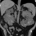 Autosomal dominant polycystic kidney disease (Radiopaedia 36539-38101 Coronal non-contrast 24).jpg