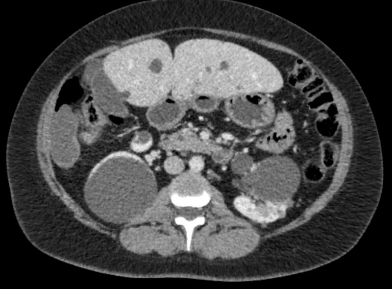 File:Autosomal dominant polycystic kidney disease (Radiopaedia 57124-64017 A 54).jpg