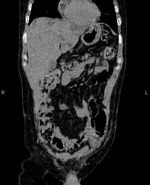 File:Autosomal dominant polycystic kidney disease (Radiopaedia 87830-104287 Coronal non-contrast 11).jpg