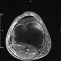 Avulsion fracture of the fibular head (Radiopaedia 74804-85808 Axial PD fat sat 25).jpg