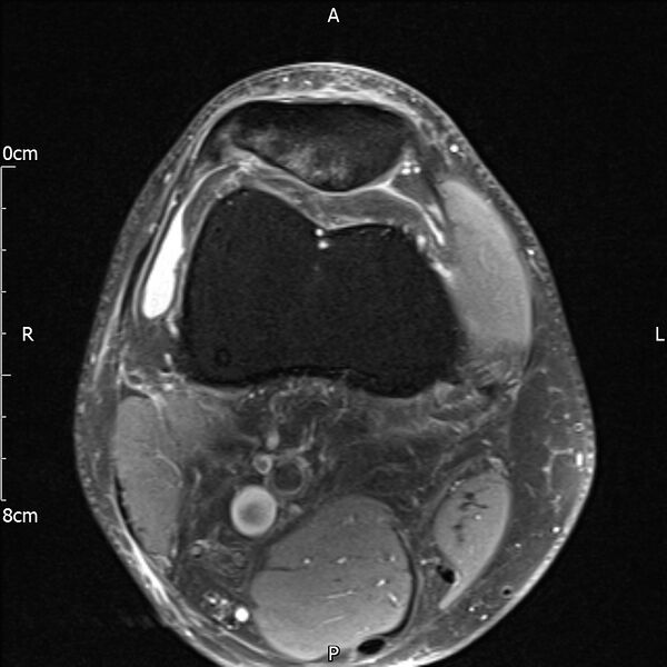 File:Avulsion fracture of the fibular head (Radiopaedia 74804-85808 Axial PD fat sat 7).jpg