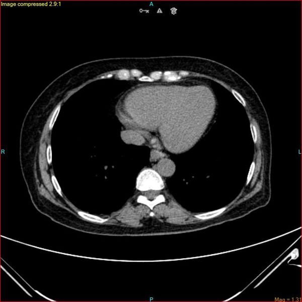 File:Azygos vein aneurysm (Radiopaedia 77824-90130 A 41).jpg