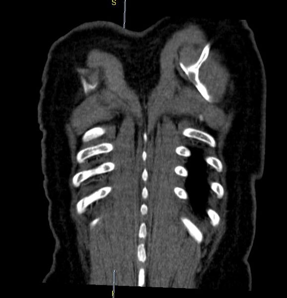File:Azygos vein aneurysm (Radiopaedia 77824-90130 C 29).JPG
