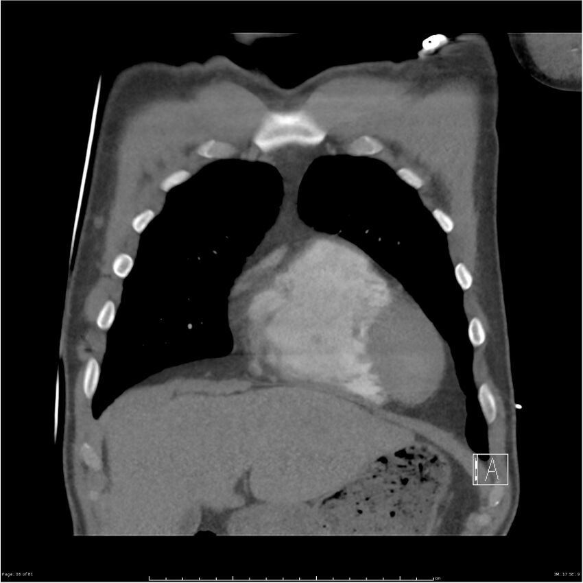 Azygos venous system anatomy (CT pulmonary angiography) (Radiopaedia 25928-26077 Coronal C+ CTPA 16).jpg
