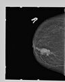 BIRADS V lesion (Radiopaedia 24039-24250 B 1).jpg