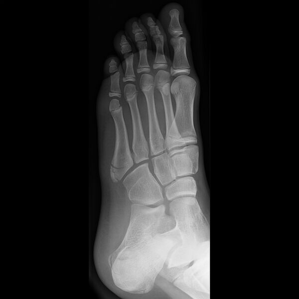 File:Base of 5th metatarsal fracture and apophysis (Radiopaedia 10842-11272 Oblique 1).jpg