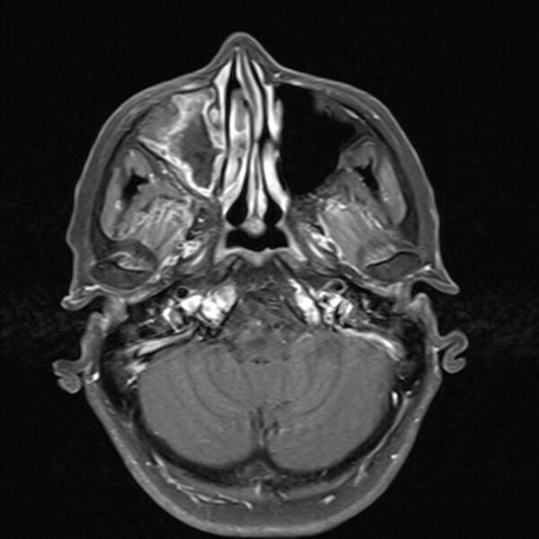 File:Base of skull chondrosarcoma (Radiopaedia 30410-31070 Axial T1 C+ fat sat 7).jpg
