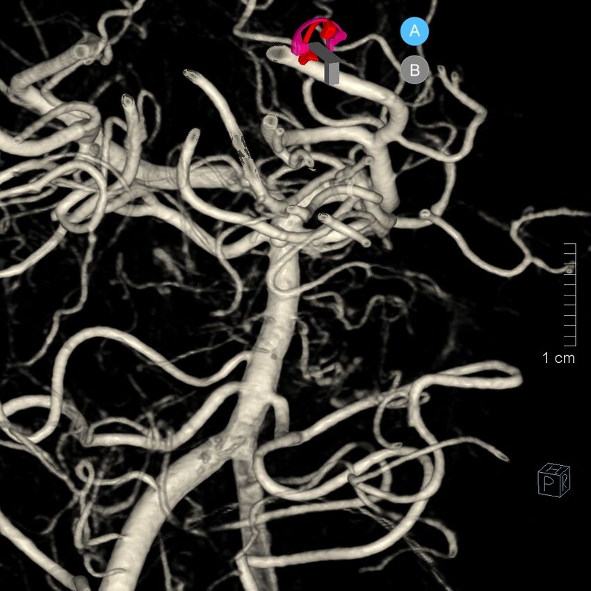 Basilar artery perforator aneurysm (Radiopaedia 82455-97734 3D view left VA 81).jpg