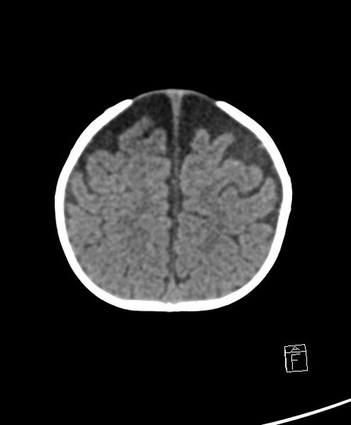 File:Benign enlargement of subarachnoid spaces in infancy (BESS) (Radiopaedia 87459-103795 Axial non-contrast 17).jpg