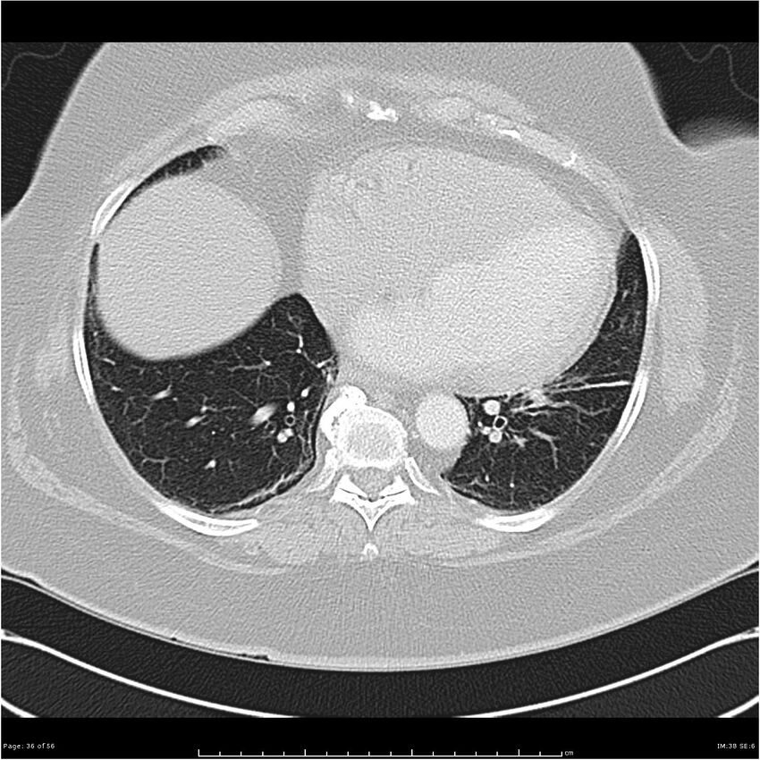 Benign metastasizing leiomyoma (Radiopaedia 26803-26962 Axial lung window 36).jpg