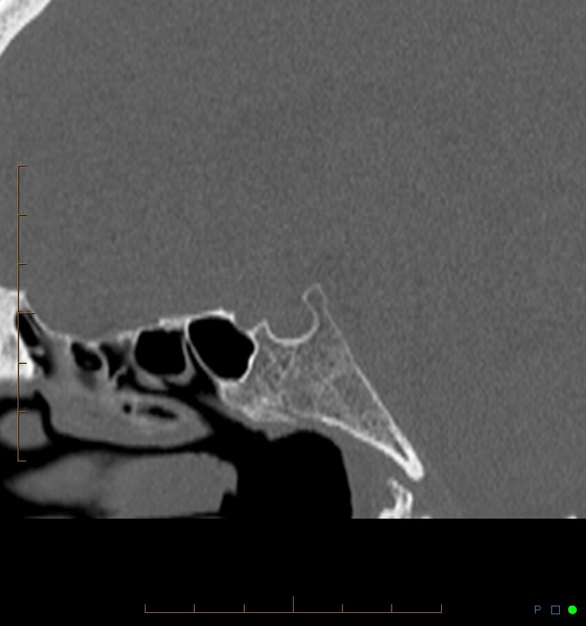 Benign notochordal cell tumor (probable) (Radiopaedia 65475-74546 Sagittal bone window 29).jpg