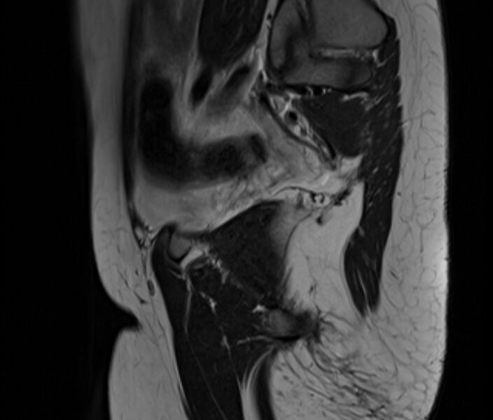 File:Bicornuate uterus (Radiopaedia 71214-81511 Sagittal T2 2).jpg