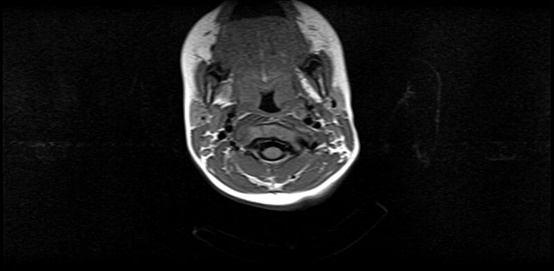 File:Bilateral Sprengel deformity with Klippel-Feil syndrome (Radiopaedia 66395-75650 Axial T1 8).jpg