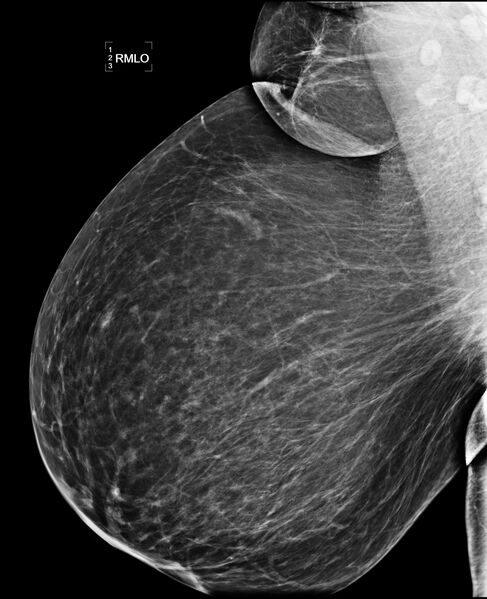 File:Bilateral accessory breast tissue (Radiopaedia 54239-60437 Right MLO 1).jpg