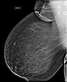 Bilateral accessory breast tissue (Radiopaedia 54239-60437 Right MLO 1).jpg