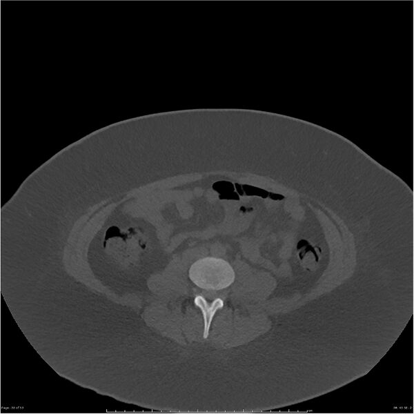 File:Bilateral lumbar ribs (Radiopaedia 25862-26010 bone window 30).jpg
