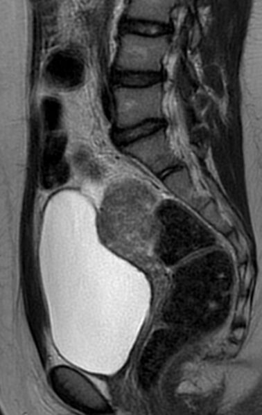 File:Bilateral ovarian fibrothecomas - adolescent (Radiopaedia 86604-102707 Sagittal T2 19).jpg