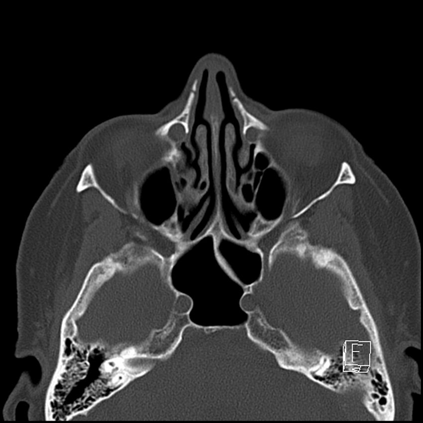 Bilateral palatine tonsilloliths on OPG and CT (Radiopaedia 75167-86247 Axial bone window 14).jpg