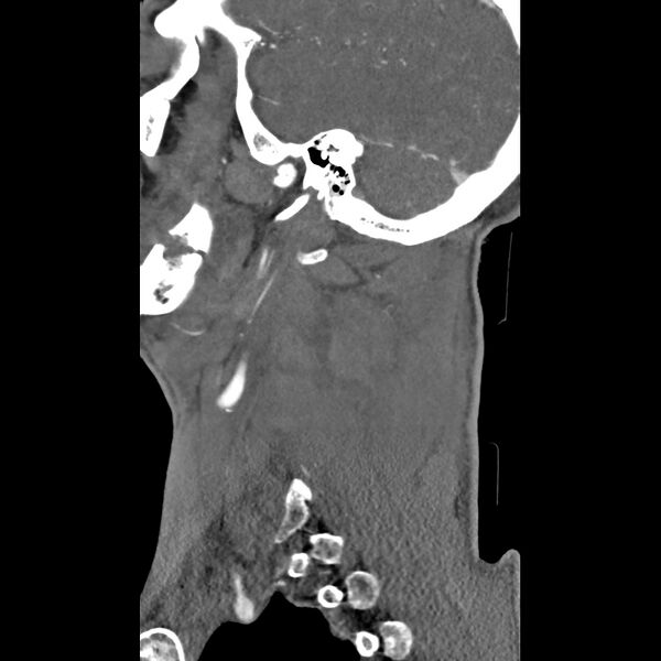 File:Bilateral perched facets with cord injury (Radiopaedia 45587-49713 B 44).jpg