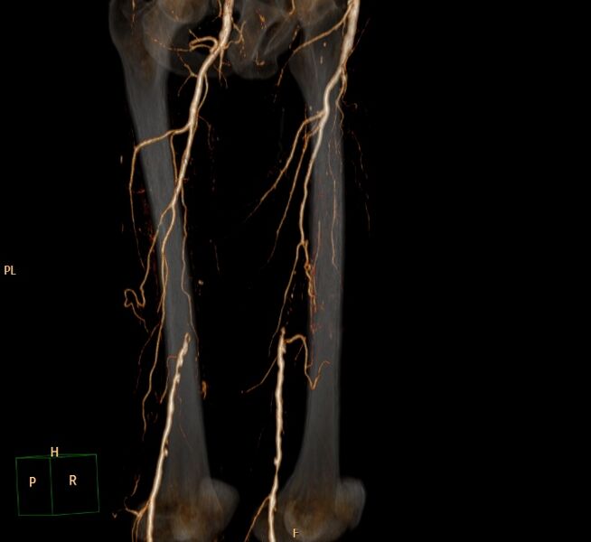 File:Bilateral superficial femoral arterial occlusion (Radiopaedia 25682-25857 3D VR 8).jpg
