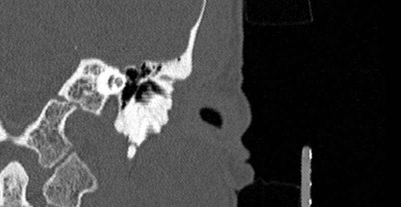 File:Bilateral temporal bone fractures (Radiopaedia 29482-29970 B 14).jpg