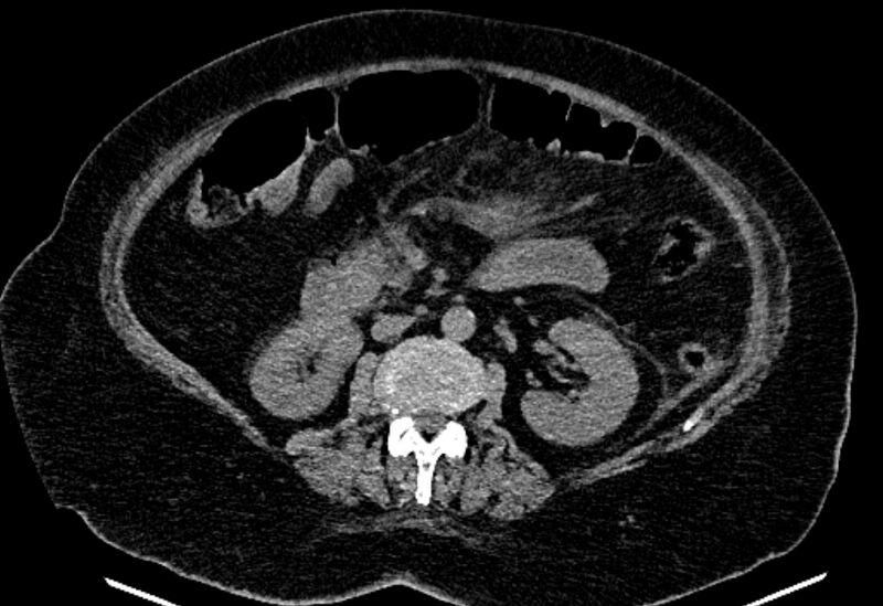 File:Biliary pancreatitis (Radiopaedia 72289-82823 Axial non-contrast 126).jpg