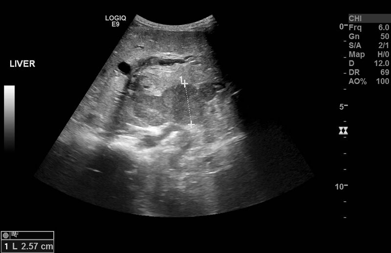 File:Biliary tract embryonal rhabdomyosarcoma (Radiopaedia 51815-57615 Oblique 1).jpg
