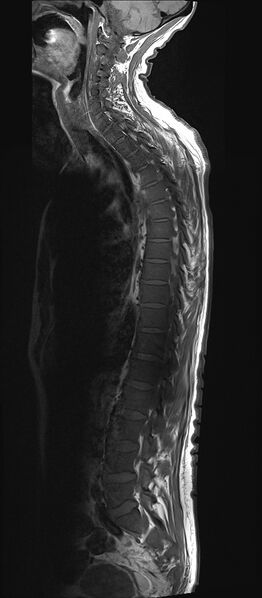 File:Bing-Neel syndrome (Radiopaedia 71453-81799 Sagittal T1 10).jpg