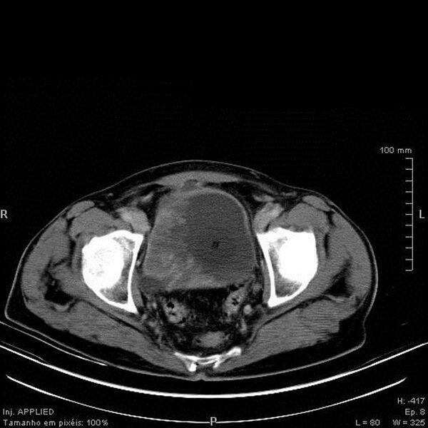 File:Bladder squamous cell carcinoma (Radiopaedia 14130-13984 B 9).jpg