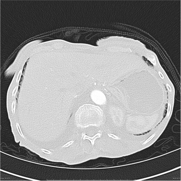 File:Boerhaave syndrome (Radiopaedia 26240-26362 Axial lung window 45).jpg