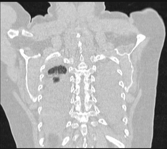 File:Boerhaave syndrome (Radiopaedia 45644-49799 Coronal lung window 60).jpg