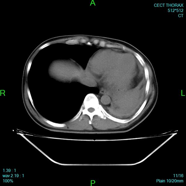 File:Bone metastases from lung carcinoma (Radiopaedia 54703-60937 Axial non-contrast 10).jpg