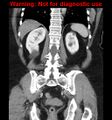 Bosniak renal cyst - type II (Radiopaedia 23404-23468 E 33).jpg