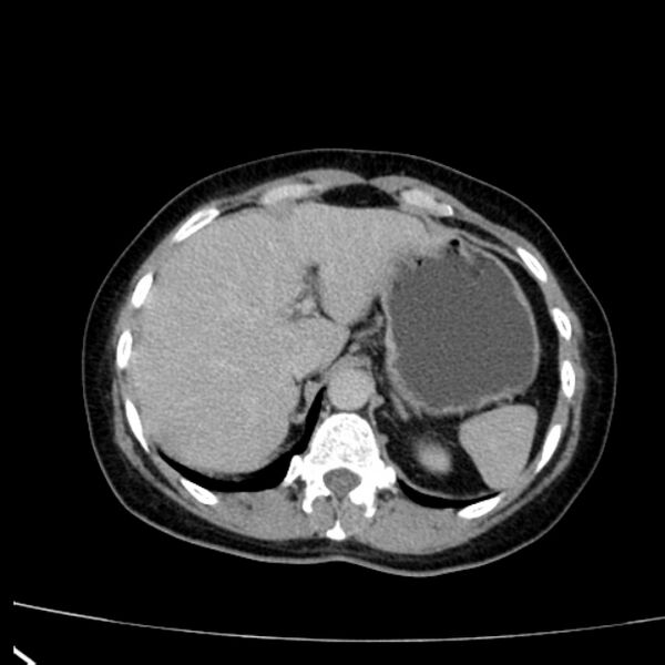 File:Bosniak renal cyst - type I (Radiopaedia 27479-27675 D 2).jpg