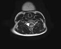 Brachial plexus birth palsy (Radiopaedia 68118-77604 Axial T2 12).jpg