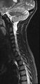 Brachial plexus birth palsy (Radiopaedia 68118-77604 Sagittal STIR 9).jpg