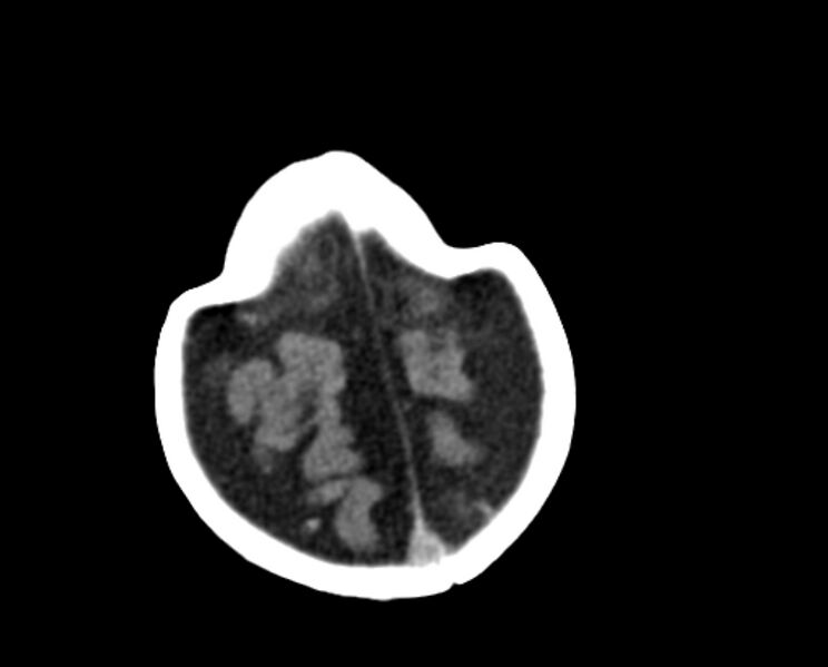 File:Brachycephaly (bi-coronal and bi-lambdoid synostosis) (Radiopaedia 55048-61413 Axial non-contrast 48).jpg