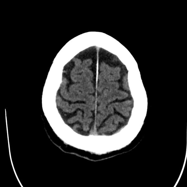 File:Brain Pantopaque remnants (Radiopaedia 78403-91048 Axial non-contrast 78).jpg